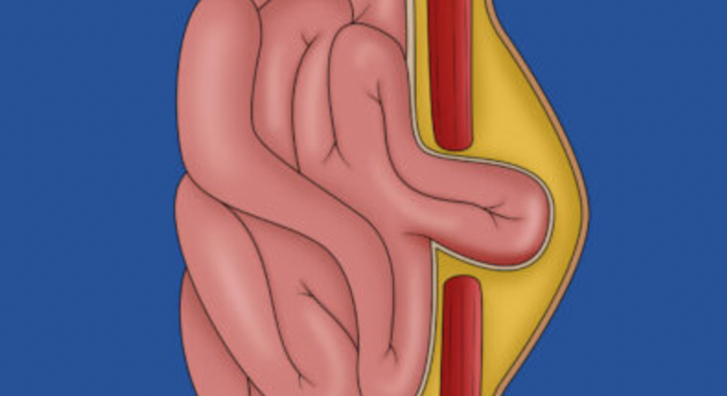 Narbenhernie  | Narbenbruchoperationen mit dem DaVinci System - OA Dr. Teodor Kapitanov, FEBS - AWS - Allgemeinchirurg/Viszeralchirurg Wien 1060