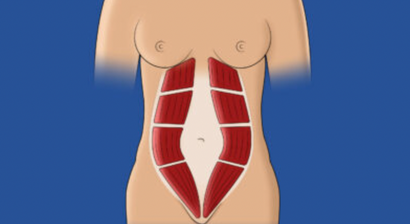 Rektusdiastase  | "MummyTummy" 