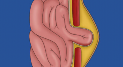 Nabelhernie  | Nabelbruchoperationen mit dem DaVinci System