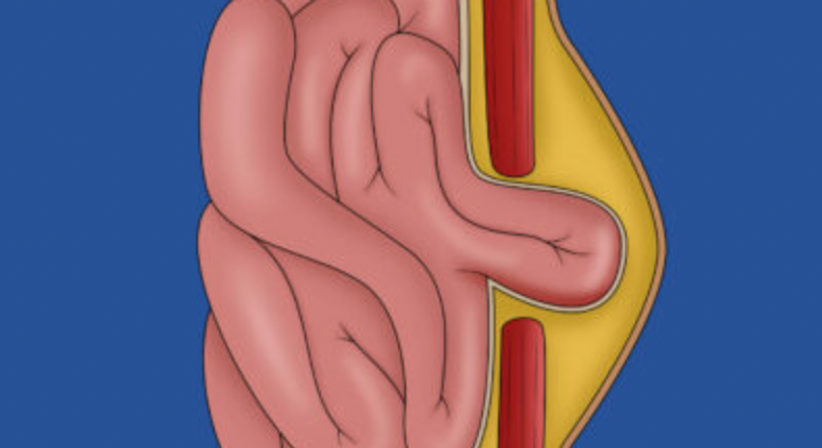 Nabelhernie  | Nabelbruchoperationen mit dem DaVinci System - OA Dr. Teodor Kapitanov, FEBS - AWS - Allgemeinchirurg/Viszeralchirurg Wien 1060