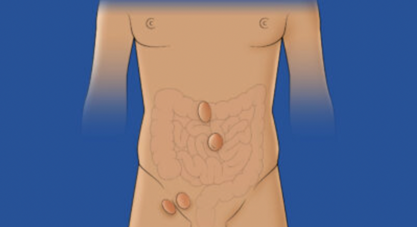 Spezialist für Bauchwand- und Hernienchirurgie in Wien (FEBS - AWS) - OA Dr. Teodor Kapitanov, FEBS - AWS - Allgemeinchirurg/Viszeralchirurg Wien 1060