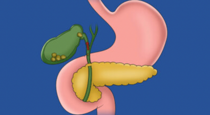 Gallenblasenoperation | Gallensteine entfernen mit dem DaVinci System