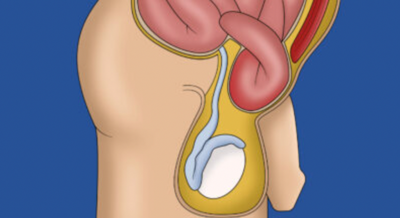 Leistenhernie | Leistenbruchoperationen mit dem DaVinci System - OA Dr. Teodor Kapitanov, FEBS - AWS - Allgemeinchirurg/Viszeralchirurg Wien 1060