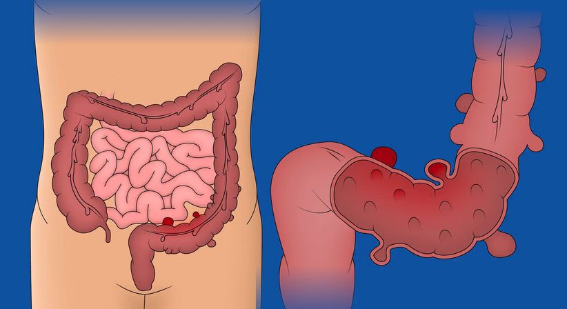 Darmchirurgie | Divertikulitis - OA Dr. Teodor Kapitanov, FEBS - AWS - Allgemeinchirurg/Viszeralchirurg Wien 1180