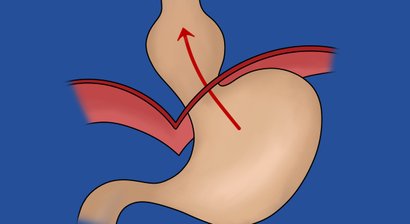 Refluxchirurgie | Zwerchfellbruch (Hiatushernie) mit dem DaVinci System 