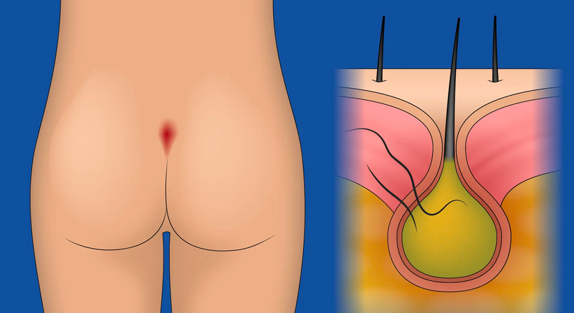 Weichteilchirurgie | Steißbeinfistel | Sakraldermoid | Lipom - OA Dr. Teodor Kapitanov, FEBS - AWS - Allgemeinchirurg/Viszeralchirurg Wien 1180