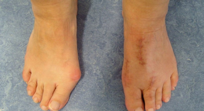 Hallux valgus - Dr. med. univ. Georg Neubauer - Orthopäde Neunkirchen 2620