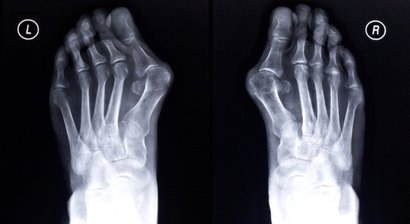 Hallux valgus