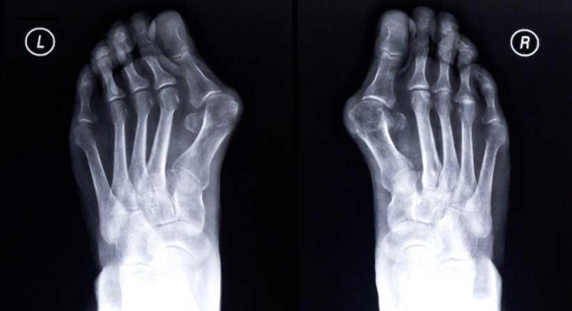 Hallux valgus - Dr. med. univ. Georg Neubauer - Orthopäde Bad Fischau-Brunn 2721