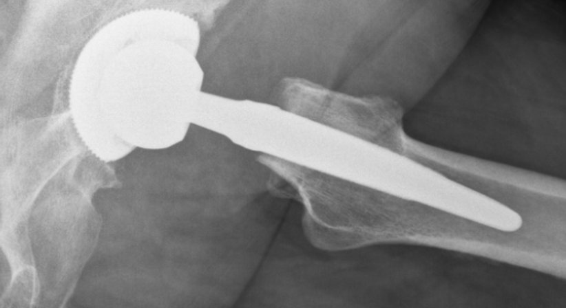 Hüftprothese - Dr. med. univ. Georg Neubauer - Orthopäde Bad Fischau-Brunn 2721