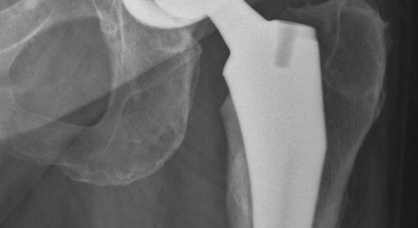 Hüftprothese - Dr. med. univ. Georg Neubauer - Orthopäde Bad Fischau-Brunn 2721