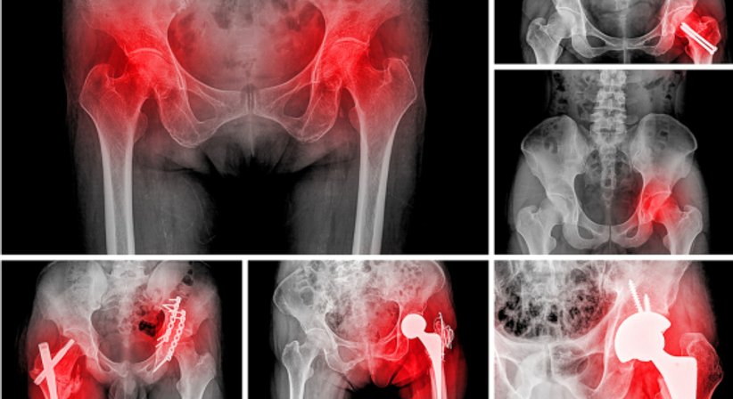 Hüftprothese - Dr. med. univ. Georg Neubauer - Orthopäde Bad Fischau-Brunn 2721