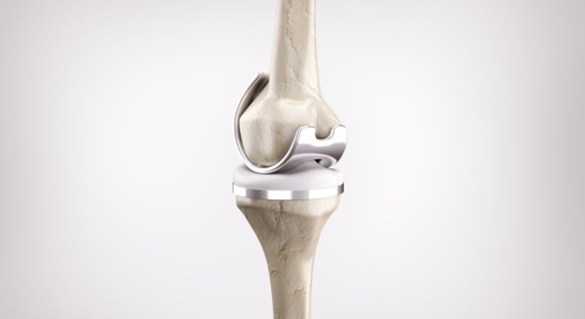 Knieprothese - Dr. med. univ. Georg Neubauer - Orthopäde Bad Fischau-Brunn 2721