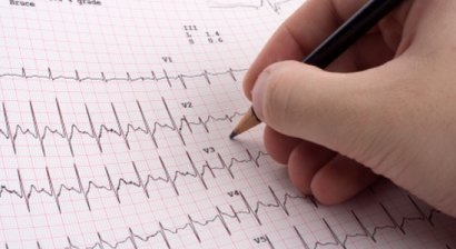 EKG
