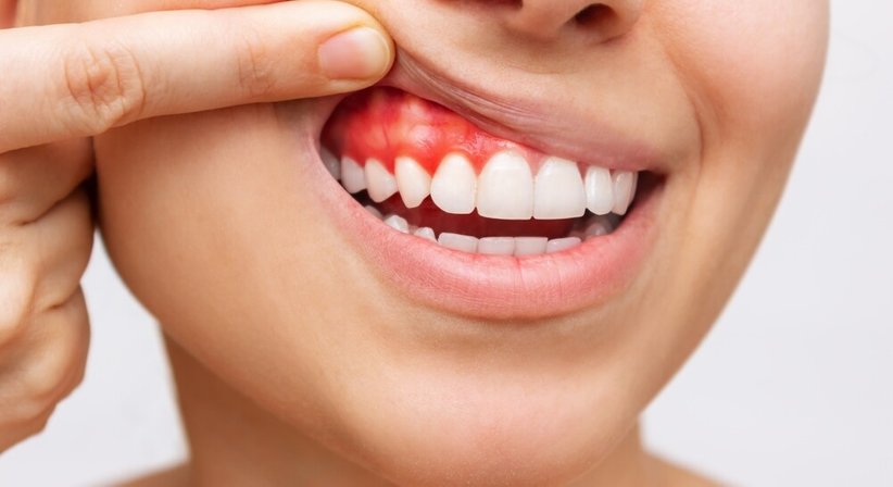 Konservative Parodontalbehandlung  - Dr. med. dent. Veit Vinzenz Fiala - Zahnarzt Wien 1010