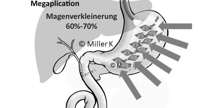 Univ.Doz. Dr. Prof. Karl  Miller - Allgemeinchirurg/Viszeralchirurg Salzburg 5020
