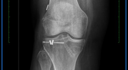 rekonstruktive Kniechirurgie