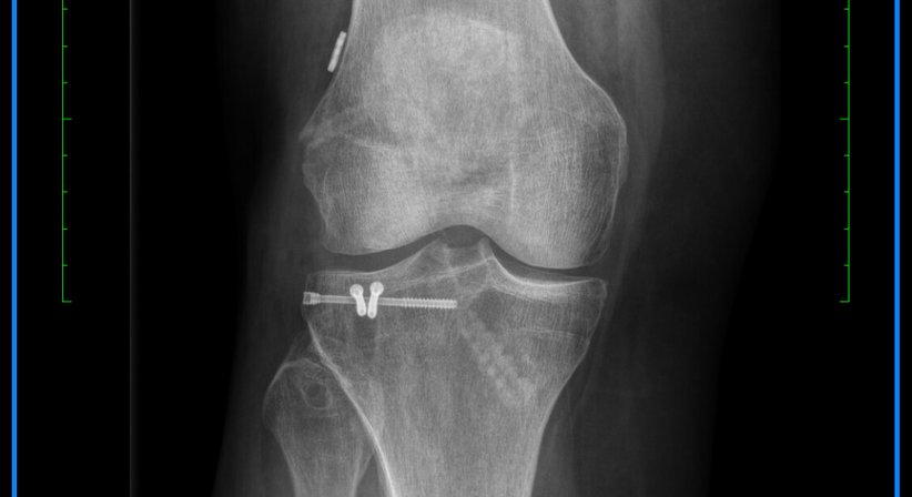 rekonstruktive Kniechirurgie - OA Dr. Dominik Roider - Orthopäde Wien 1180