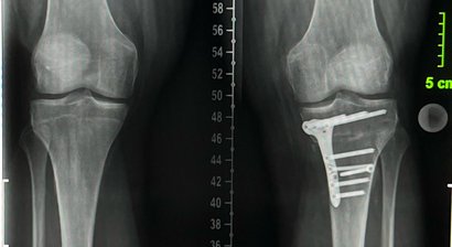 Osteotomie - Beinachsenkorrektur