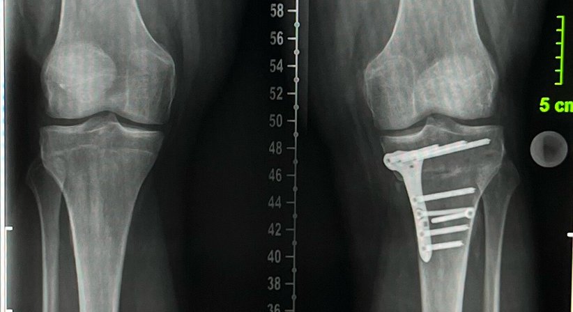 Osteotomie - Beinachsenkorrektur - OA Dr. Dominik Roider - Orthopäde Wien 1180
