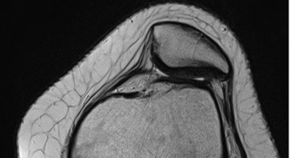 Therapie der instabilen Kniescheibe - Patelluxation