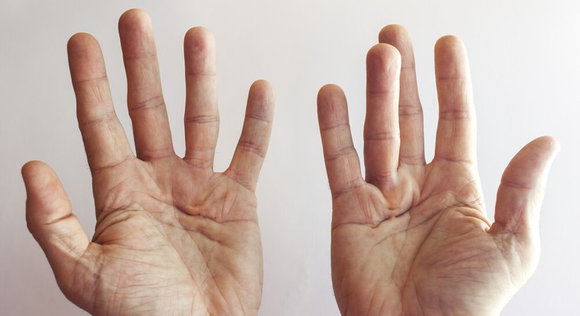 Handchirurgie - OA Priv. Doz. Dr. Christoph Stihsen - Orthopäde Wien 1150