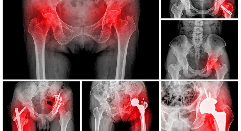 Hüft- und Kniegelenksendoprothesen (Künstliches Hüft- und Kniegelenk) - OA Priv. Doz. Dr. Christoph Stihsen - Orthopäde Wien 1150