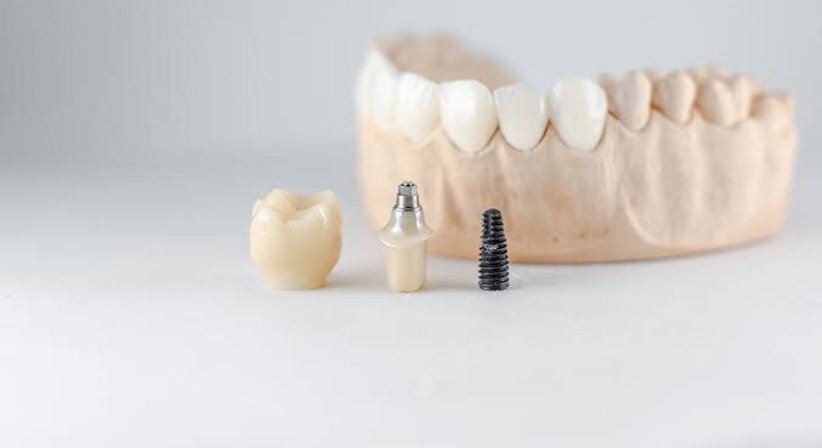 Implantologie & Festsitzender Zahnersatz (Digital & Präzise) bei Dr. med. dent. Ditjon Bytyqi