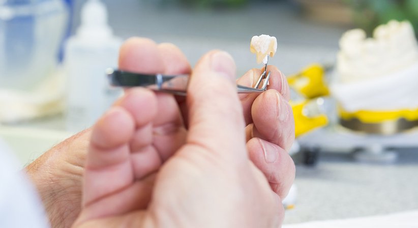 Inlays / Onlays - DDr. Anna Jung - Zahnärztin Wien 1120