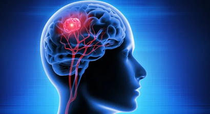Hypophysenadenom (Gehirntumor)