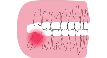 Operative Weisheitszahn-Entfernung