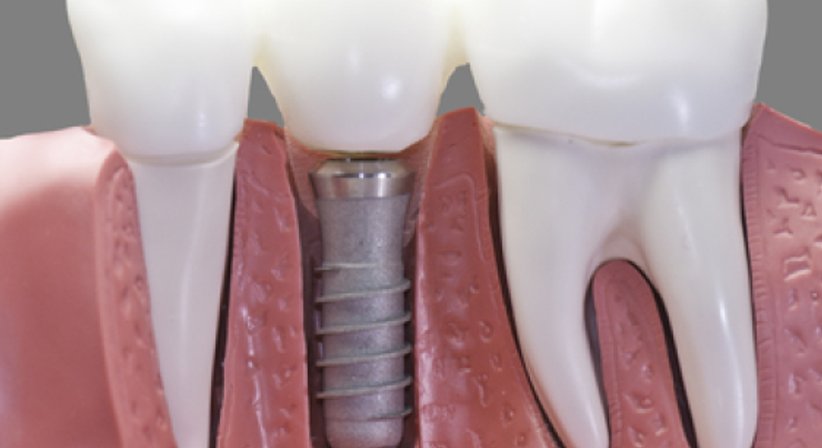 Implantate - Dr. med. dent. Azam Gomari - Zahnärztin Wien 1210