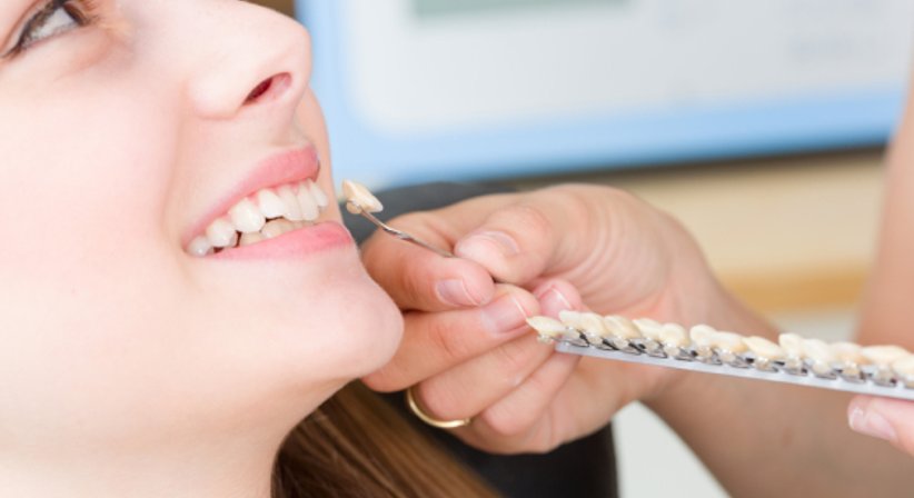 Veneers - Dr. med. dent. Azam Gomari - Zahnärztin Wien 1210