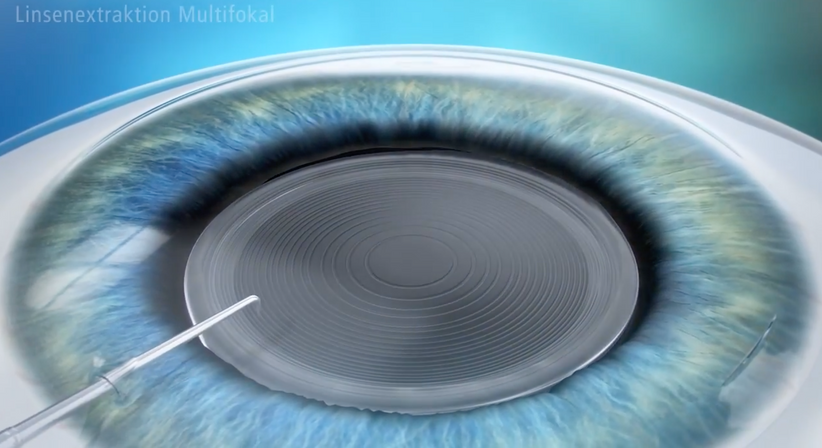 Grauer Star (Katarakt)  - Prof. Dr. Dr.  Nikolaus Luft, FEBO, FWCRS - Augenarzt Linz 4020