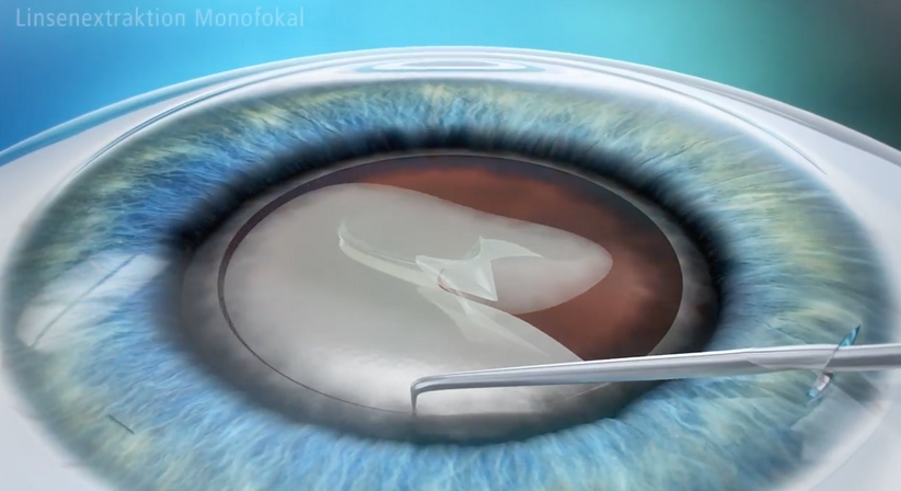 Grauer Star (Katarakt)  - Prof. Dr. Dr.  Nikolaus Luft, FEBO, FWCRS - Augenarzt Linz 4020