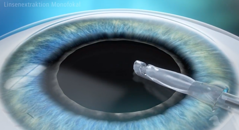 Grauer Star (Katarakt)  - Prof. Dr. Dr.  Nikolaus Luft, FEBO, FWCRS - Augenarzt Linz 4020