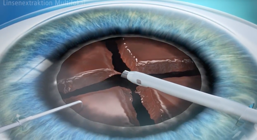 Grauer Star (Katarakt)  - Prof. Dr. Dr.  Nikolaus Luft, FEBO, FWCRS - Augenarzt Linz 4020