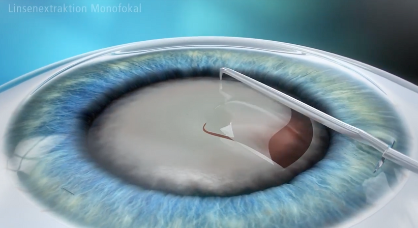 Grauer Star (Katarakt)  - Prof. Dr. Dr.  Nikolaus Luft, FEBO, FWCRS - Augenarzt Linz 4020