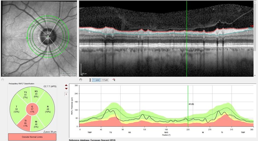 Grüner Star (Glaukom)  - Prof. Dr. Dr.  Nikolaus Luft, FEBO, FWCRS - Augenarzt Linz 4020