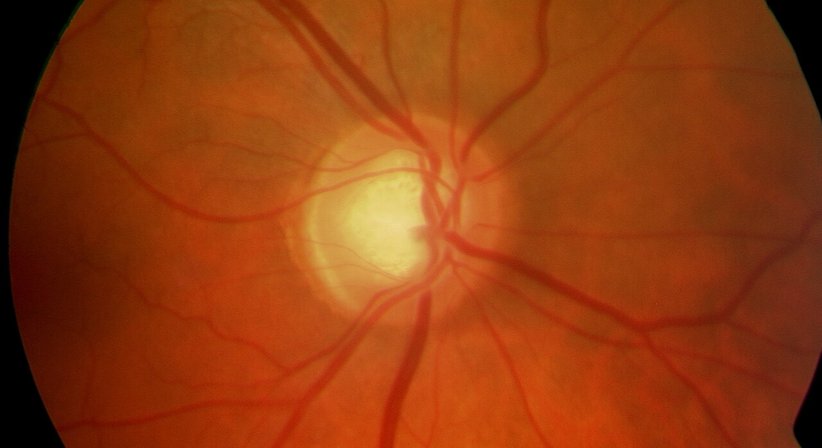 Grüner Star (Glaukom)  - Prof. Dr. Dr.  Nikolaus Luft, FEBO, FWCRS - Augenarzt Linz 4020