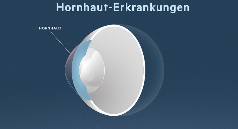 Hornhaut-Erkrankungen - Prof. Dr. Dr. Nikolaus Luft, FEBO, FWCRS - Augenarzt Linz 4020