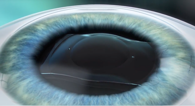 ICL – Implantierbare Collamer Linse - Prof. Dr. Dr.  Nikolaus Luft, FEBO, FWCRS - Augenarzt Linz 4020