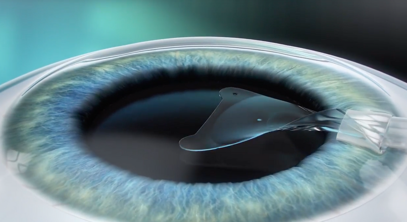 ICL – Implantierbare Collamer Linse - Prof. Dr. Dr.  Nikolaus Luft, FEBO, FWCRS - Augenarzt Linz 4020