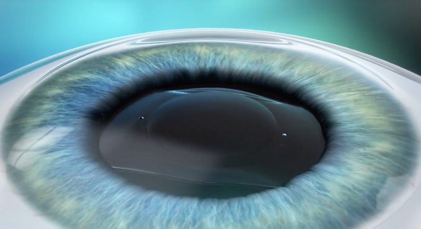 ICL – Implantierbare Collamer Linse - Prof. Dr. Dr.  Nikolaus Luft, FEBO, FWCRS - Augenarzt Linz 4020