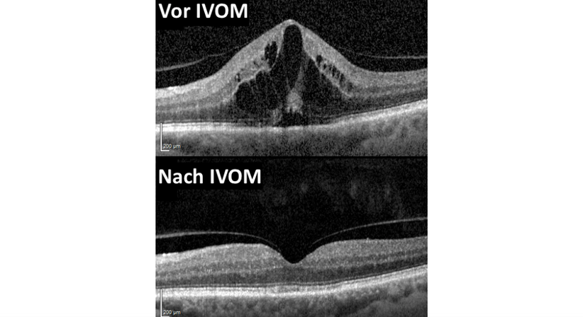 IVOM (Intravitreale Medikamenteneingabe) - Prof. Dr. Dr.  Nikolaus Luft, FEBO, FWCRS - Augenarzt Linz 4020