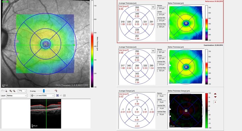 Makula-Erkrankungen - Prof. Dr. Dr.  Nikolaus Luft, FEBO, FWCRS - Augenarzt Linz 4020