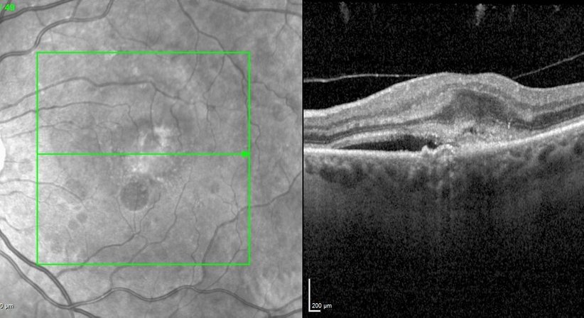 Makula-Erkrankungen - Prof. Dr. Dr.  Nikolaus Luft, FEBO, FWCRS - Augenarzt Linz 4020