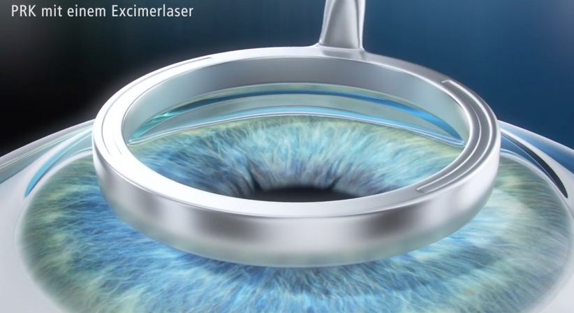 PRK (LASEK) - Prof. Dr. Dr.  Nikolaus Luft, FEBO, FWCRS - Augenarzt Linz 4020