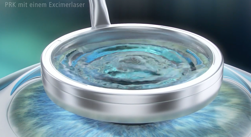 PRK (LASEK) - Prof. Dr. Dr.  Nikolaus Luft, FEBO, FWCRS - Augenarzt Linz 4020