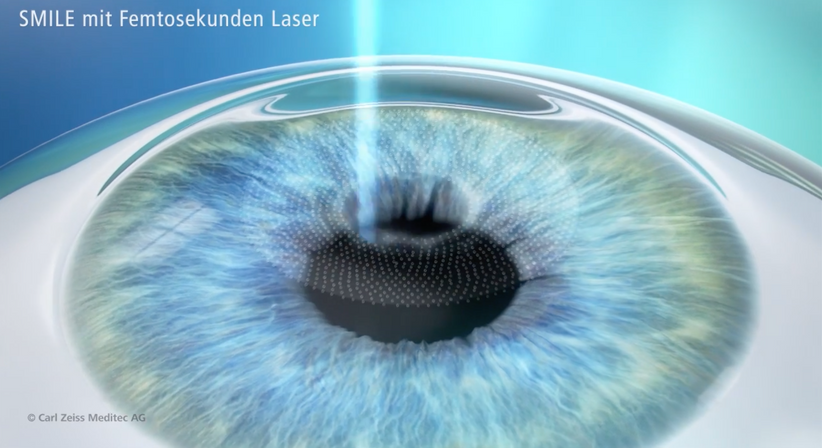 Relex SMILE - Prof. Dr. Dr.  Nikolaus Luft, FEBO, FWCRS - Augenarzt Linz 4020